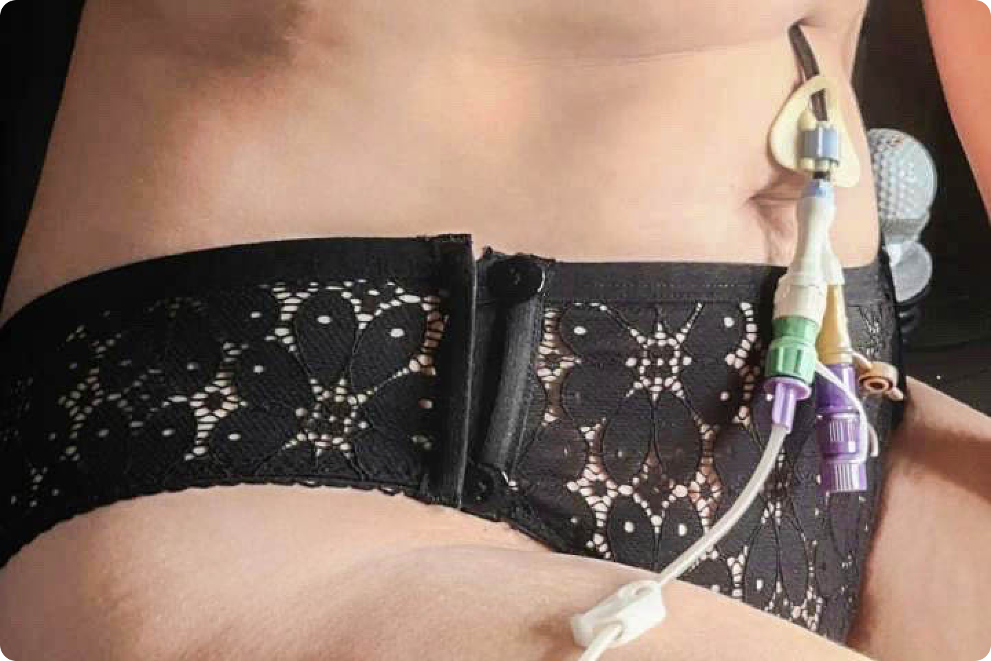 A close-up of a person's abdomen showing a medical device attached to their skin with adhesive. The person is wearing Clip-Knix black lace underwear, and there are tubes connected to the device.