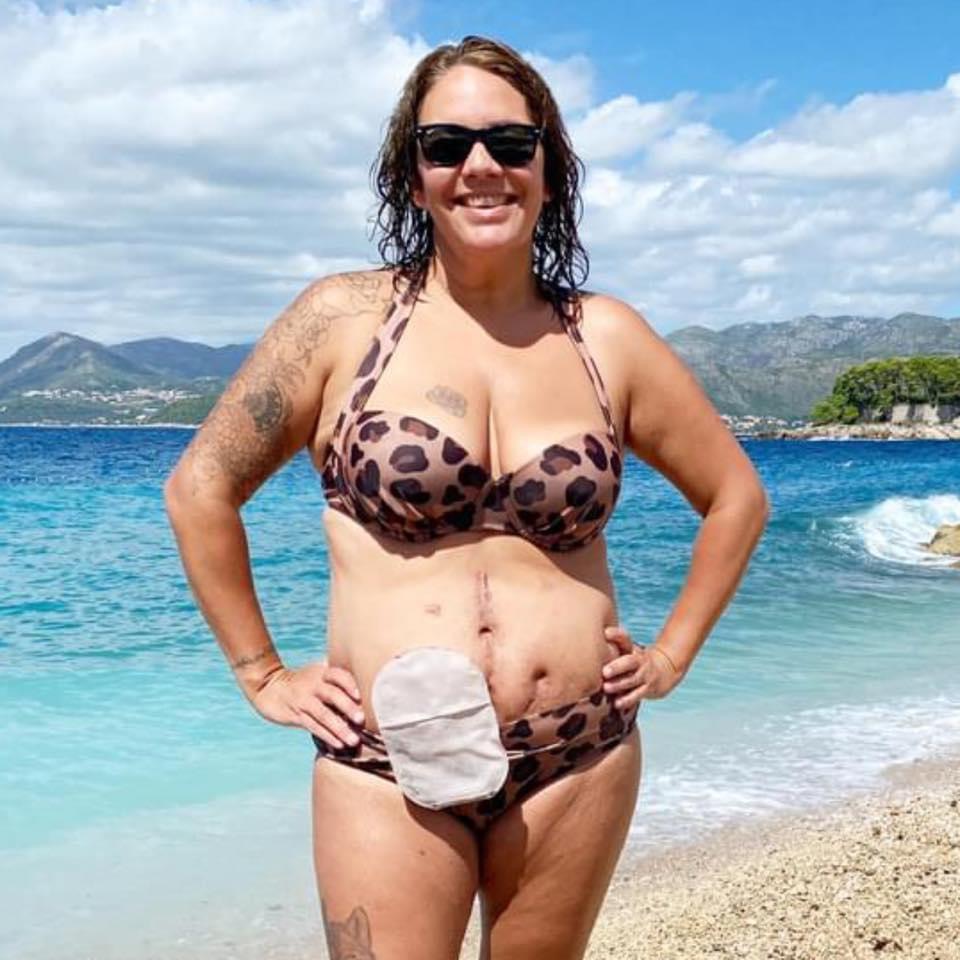 Sam is a brown woman with dark curly hair and sunglasses, she is on a beautiful beach in Croatia and is wearing a leopard print bikini, she has a lot of scars on her stomach and an ileostomy stoma bag, she is smiling and looks proud and happy